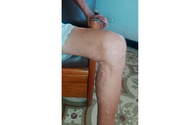 Las cicatricesde Tiburcio  en su pierna izquierda como evidencias por el ataque del tiburón.